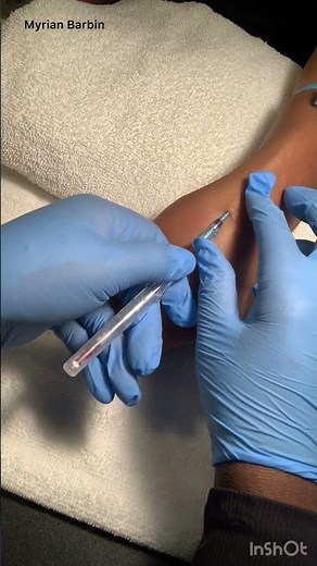 How to start an IV in the Wrist
