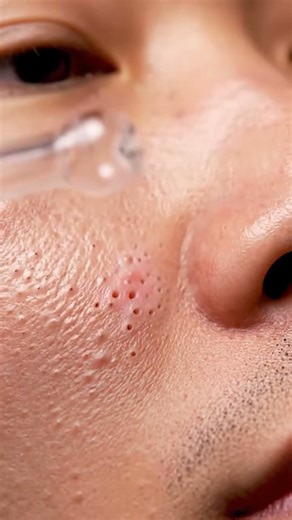 Blackhead Clearing Therapy — Satisfying