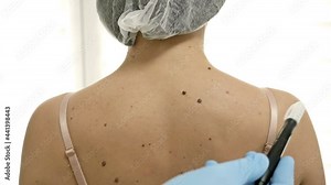 Dermatologist examining moles of female patient.