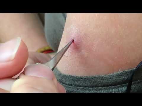 Botfly maggot remove