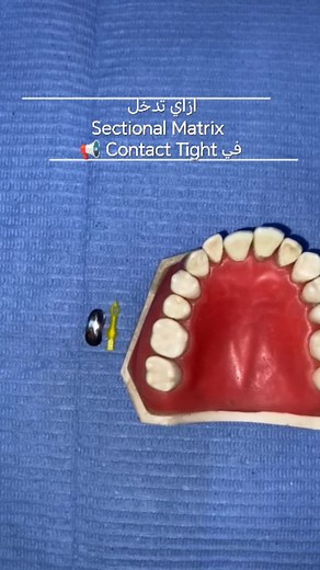 ازاي تدخل Sectional Matrix في Tight Contact من غير ما يحصلها Deformation 🤔 #restorativedentistry #dentistry #dentaleducation #dentaltips | Dental Art