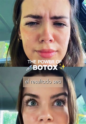 Cuidados post Botox para resultados duraderos