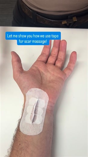 How to make scar massage tabs for scar mobilisation! This is a great way for patients to complete independent scar massage at home. It can be done on the arm, hand and fingers! #scarmassage #handtherapy #scarmanagement #handsurgery #scars | Hand Therapy Group
