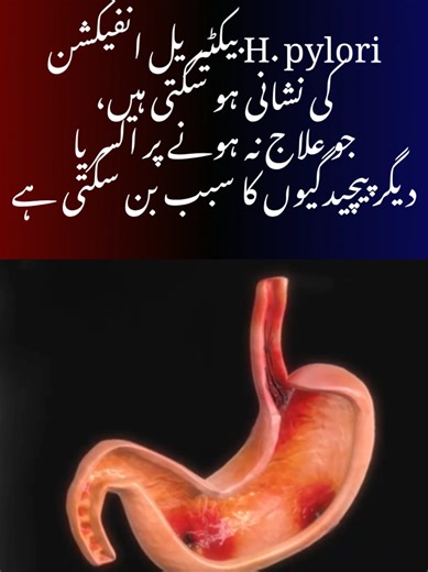 Frequent stomach pain, bloating, or nausea? It might not be just acidity , it could be H. pylori infection, a stomach infection which can lead to ulcers if untreated. #HPylori #StomachInfection #UlcerRisk #GutHealth #Bloating