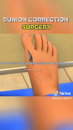 Bunion Correction Surgery: Understanding Bunion Osteotomy