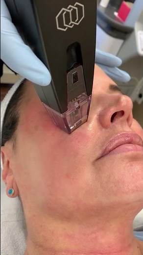 Skin care with Morpheus 8