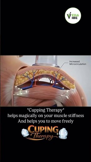 How Does Cupping Therapy Work? | Ayurvedic Cupping Treatment Explained