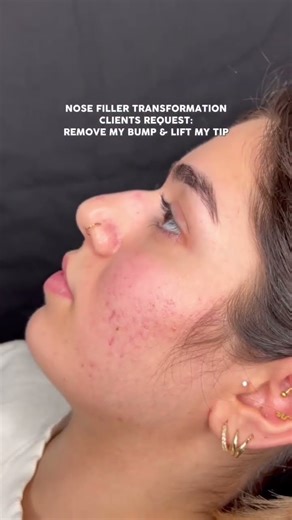 Nose filler Before After #nosefiller #nosereshape #filler #nonsurgicalrhinoplasty