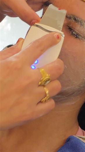 blackhead and white head removal #transformation