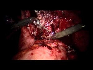 Robotic Single-Site  2 Complex Myomectomy • Video • MEDtube.net
