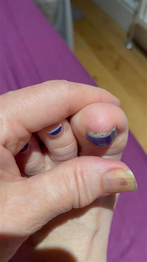 Chantal’s Journey 💅 “During my cancer treatment, my nails became one of my hardest battles. I had pus under my fingernails and toenails, they were painful, sore, and left me feeling embarrassed. I didn’t realize how much confidence my nails gave me until I lost them. Every touch, every daily task became uncomfortable. Finding Polybalm changed everything — not just how they looked, but how I felt going through treatment. 🌿✨” Patients are rarely prepared for Chemo Nails, but with Polybalm you’re