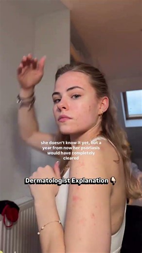 Psoriasis Treatment Has Changed More Than You Think Dermatologist Explains
