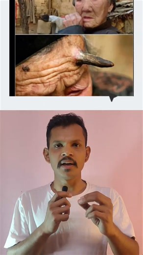 Cutaneous Horn Kya Hota Hai? Yeh Dangerous Ho Sakta Hair