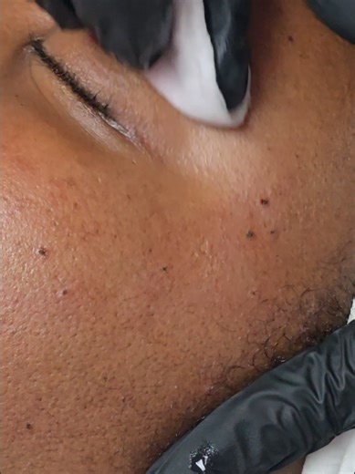 Let me explain the simple procedure of cauterisation, also known as cautery. This is a quick, non-invasive method used to remove skin tags, warts, and milia — with immediate results. First, we thoroughly sterilise the skin, followed by applying a numbing cream. After about 10 to 15 minutes, we begin the procedure. You may feel a slight warm sensation during treatment, but there’s no discomfort afterward. For your peace of mind, a brand-new sterile needle is used for every client — and the needle