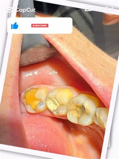 Save the Nerve! Lower First Molar Restoration 😱