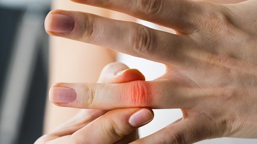Arthrose in den Fingern: Diese 11 Hausmittel helfen