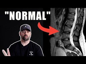 My MRI is Normal, So Why Do I Have Back Pain?