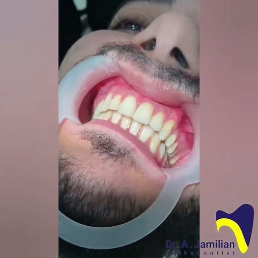 Debonding Procedure in Orthodontics #dentist #debonding #orthodontics #dentist #bracket #debanding