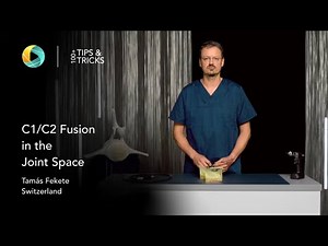 C1–C2 Fusion in the Joint Space by Tamás Fekete #spinalfusion