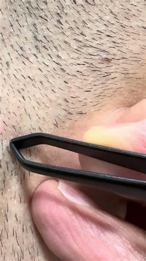 Skincare satisfying videos #pimple #pimples #pimplepopping #remove #hairremoval #gross #thickhair