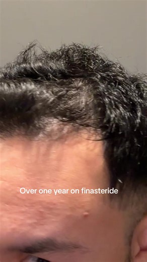 Understanding Finasteride and Its Effects