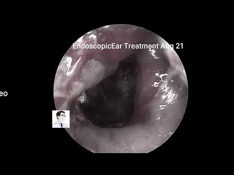 Management of external auditory canal cholesteatoma under general anesthesia, 11 minutes