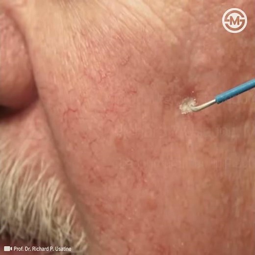 How Does Cryosurgery (Cryotherapy - Cryoablation) Works #medical #video #shorts