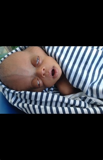 September 2025, Nilsa alifanyiwa vipimo vya kichwa vya CT Scan na MRI na hivyo kubainika na maji mengi pembeni ya fuvu la kichwa na utosini. hapo alikuwa anaandaliwa tayari kwenda kufanyiwa upasuaji.✨ #nilsa_simon #fyp #tiktok #tiktoktanzania🇹🇿