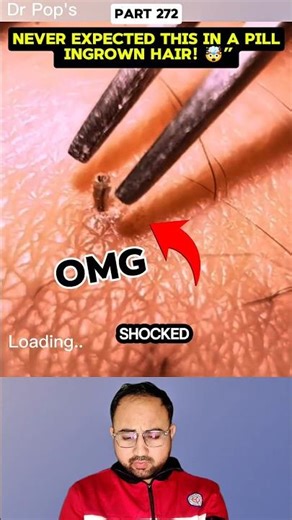 Never Expected This in a Pill… Ingrown Hair! #shorts