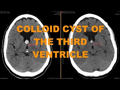 Clinical case - enlarging colloid cyst of the third ventricle - important finding not to miss on CT