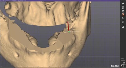 Great Impressions Dental Lab on Instagram: "Bone reduction guide + carrier guide designed in RealGuide and integrated into exocad as part of a full-arch rehabilitation workflow. Surgical planning today to support efficient MUA placement and restorative-driven AOX design next. 🦷✨ Richmond & Virginia dentists we’re happy to collaborate on complex full-arch cases. #RichmondDentist #VirginiaDentist #ImplantDentistry #AllOnX #DentalLab"