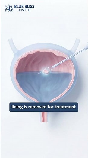 Advance Bladder Cancer Surgery: Minimally Invasive & Robotic Treatment Options | Blue Bliss Hospital