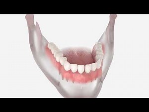 Wisdom Tooth Extraction