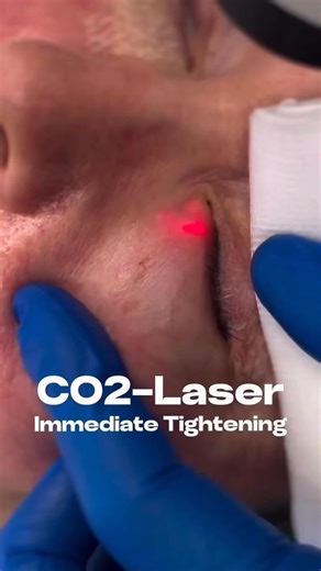 UltraPulse Alpha Under Eye Skin Tightening