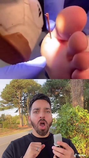 10/10 one of the greatest videos of our generation #tbt #dermdoctor #dermatologist #splinter #sliver