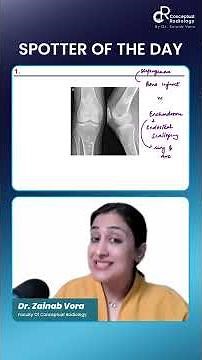 Bone Infarct vs Enchondroma | Spotter Quiz by Dr. Zainab Vora | Radiology Residency #short