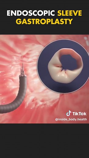 ✨ Have you ever wondered how modern weight loss surgery works? This 3D animation reveals the secrets behind the Endoscopic Sleeve Gastroplasty procedure! It's a game changer for those seeking transformation. What do you think about this innovative approach?