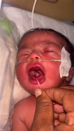 How an NG Tube Is Inserted in a Newborn Baby | NICU Procedure #NewbornBaby #NGTube #NasalTube