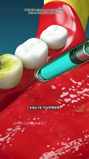 Wisdom Teeth Extraction(3D Animation)