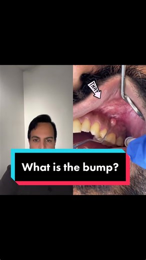 #duet with @Dr Massi Dental what is the pump on the gums? #whatsthat #infection #gum