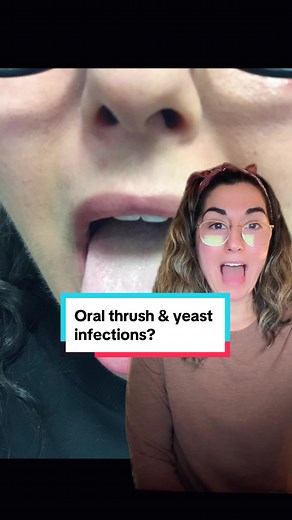 Candida Overgrowth and Oral Thrush: Symptoms, Treatment, and Prevention