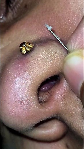 Nose Blackhead Removal 2025 - Skin Care