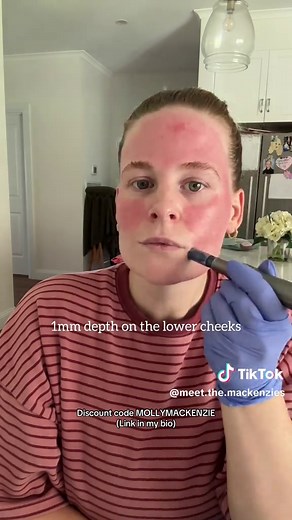 Ultimate Microneedling Experience: Before and After Results
