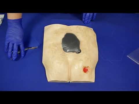NPWT Wound Dressing Application | Cork Medical