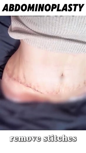 Abdominal wall shaping #腹壁成形 #軀體年輕化 #產後鬆弛 #abdominoplasty #bodyrejuvenation