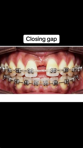 Closing the Gap on Your Braces Journey: ASMR Experience