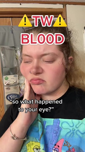 Replying to @212london212 you can definitely tell that it’s healing now :) #eye #eyes #blood #bloodvessel #fyp