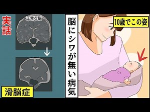 【実話】脳にシワがない滑脳症の子供の人生とは【創作】