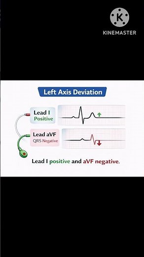 Left Axis Deviation – Easy ECG ExplanationLeft Axis Deviation in ECG (Simple Method)