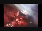 Laparoscopic Pelvic Lymphadenectomy • Video • MEDtube.net